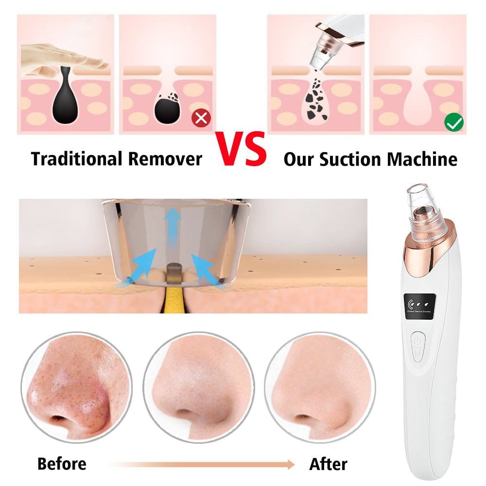 Beauty Electric Blackhead Remover - Don't Know What To Gift